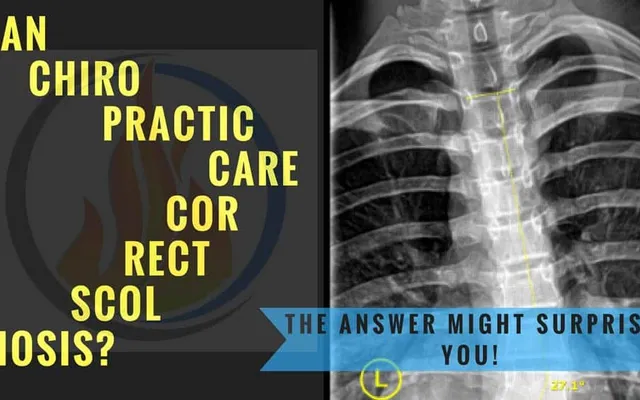 Can Chiropractic Care Correct Scoliosis?